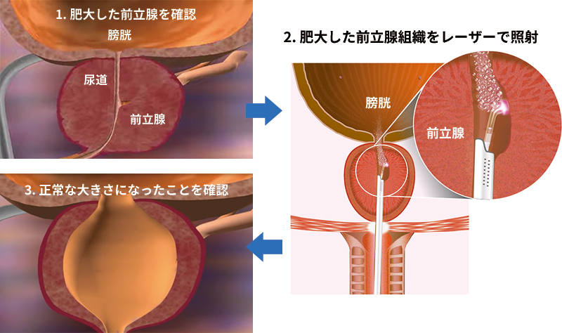 接触式前立腺レーザー治療（CVP）