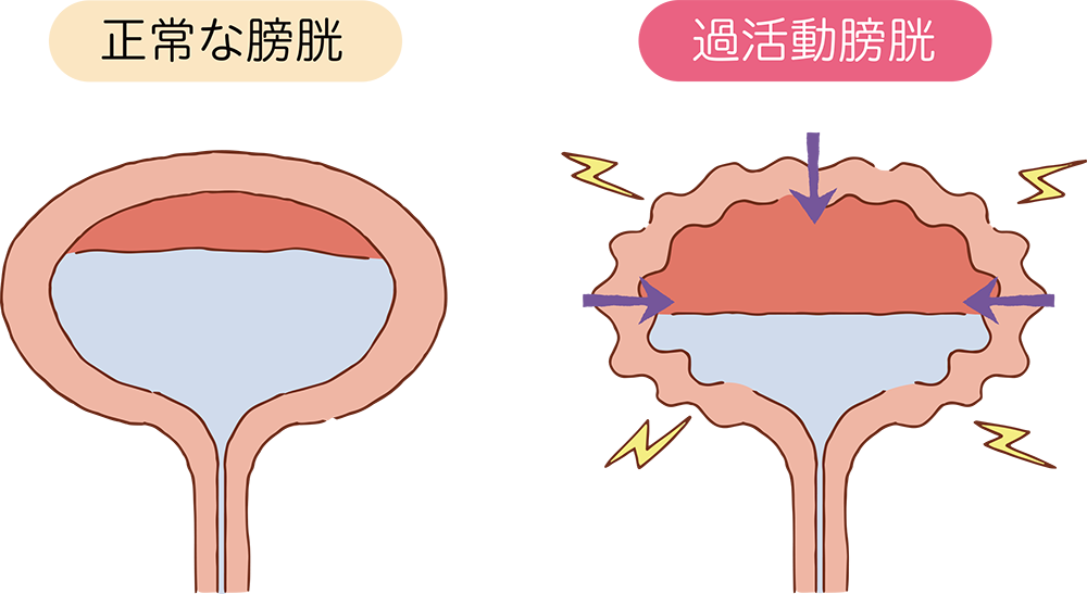 過活動膀胱が発症するしくみ