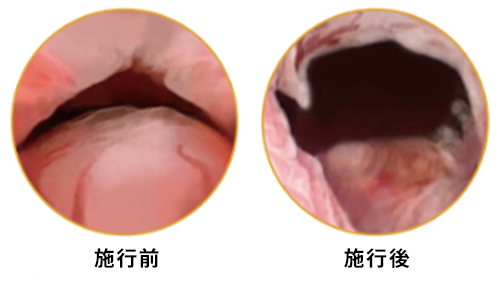 植込み型前立腺組織牽引システム治療施工前、施工後